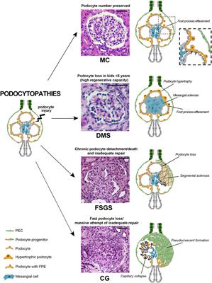 The Pathology Lesion Patterns of Podocytopathies: How and why?